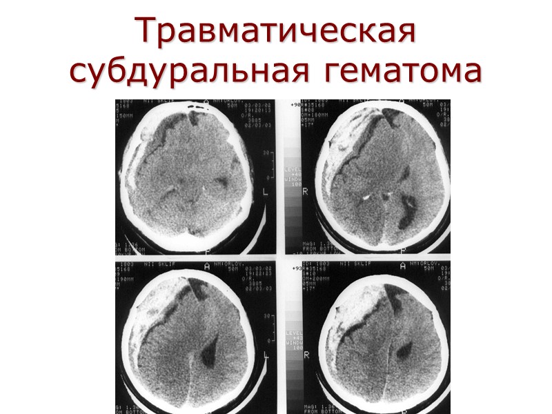 Травматическая субдуральная гематома